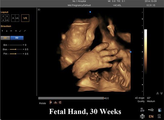 fetal hand, 30 weeks