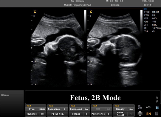 2D ultrasound scan